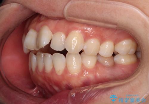 【モニター】飛び出した上顎前歯 補助装置を併用したインビザライン矯正治療の治療前