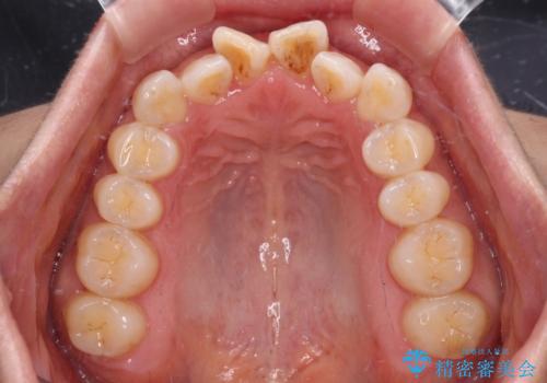 【モニター】飛び出した上顎前歯 補助装置を併用したインビザライン矯正治療の治療前