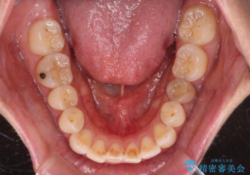 【モニター】飛び出した上顎前歯 補助装置を併用したインビザライン矯正治療の治療前