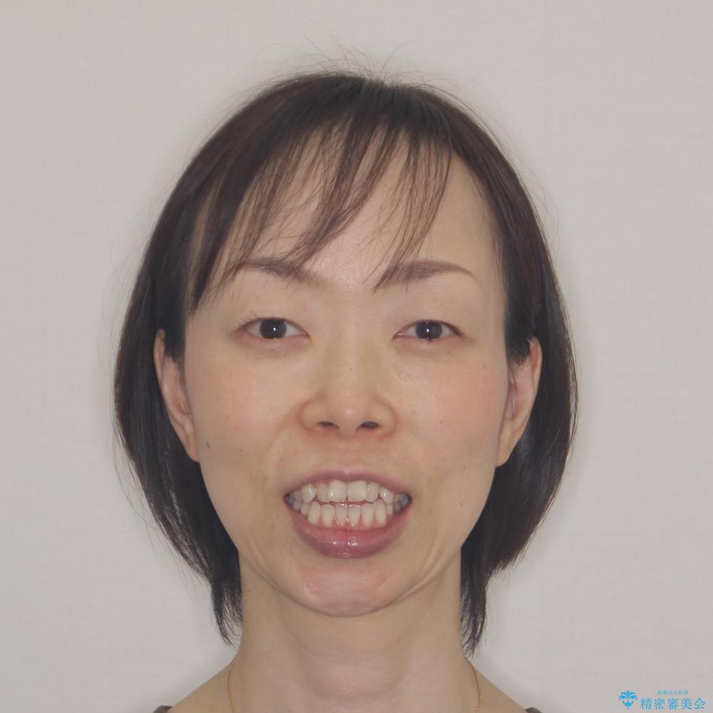 【モニター】飛び出した上顎前歯 補助装置を併用したインビザライン矯正治療の治療前(顔貌)