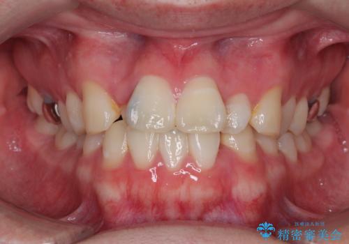 1年でここまで変わる!歯列のがたつきと正中のズレを改善した矯正治療(メタルブラケット×MARPE)の症例 治療前