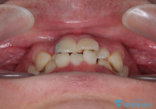 1年でここまで変わる!歯列のがたつきと正中のズレを改善した矯正治療(メタルブラケット×MARPE)の治療前