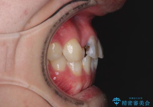 1年でここまで変わる!歯列のがたつきと正中のズレを改善した矯正治療(メタルブラケット×MARPE)の治療前