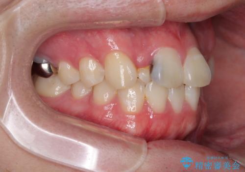 1年でここまで変わる!歯列のがたつきと正中のズレを改善した矯正治療(メタルブラケット×MARPE)の治療前