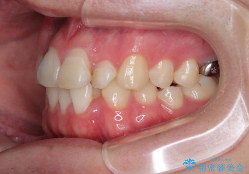 1年でここまで変わる!歯列のがたつきと正中のズレを改善した矯正治療(メタルブラケット×MARPE)の治療前