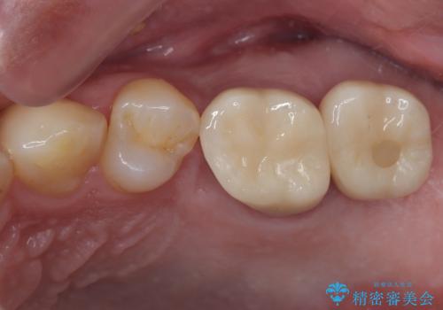 奥歯のむし歯が気になる 根管治療とインプラント治療の症例 治療後