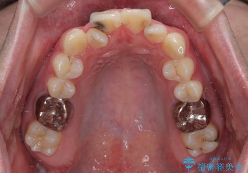 1年でここまで変わる!歯列のがたつきと正中のズレを改善した矯正治療(メタルブラケット×MARPE)の治療前