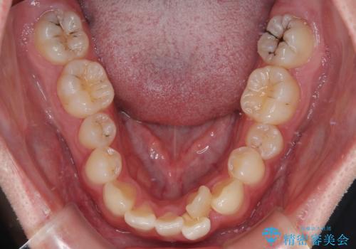 1年でここまで変わる!歯列のがたつきと正中のズレを改善した矯正治療(メタルブラケット×MARPE)の治療前