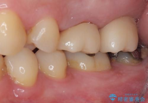 奥歯のむし歯が気になる 根管治療とインプラント治療の治療後