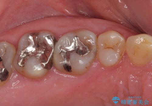 銀歯の下のむし歯 ゴールドクラウンによる補綴治療の症例 治療前