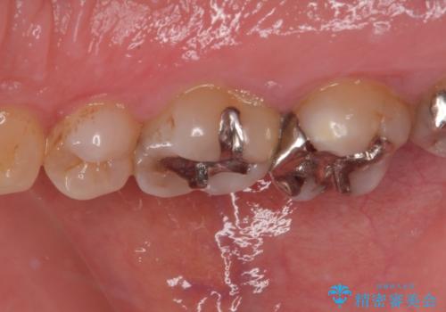 銀歯の下のむし歯 ゴールドクラウンによる補綴治療の治療前