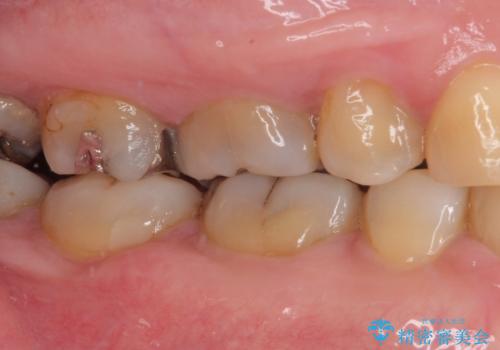 銀歯の下のむし歯 ゴールドクラウンによる補綴治療の治療前