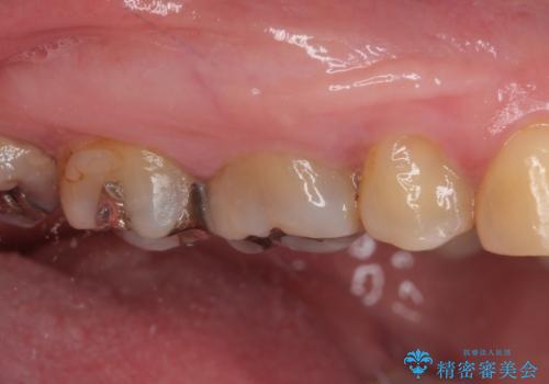 銀歯の下のむし歯 ゴールドクラウンによる補綴治療の治療前