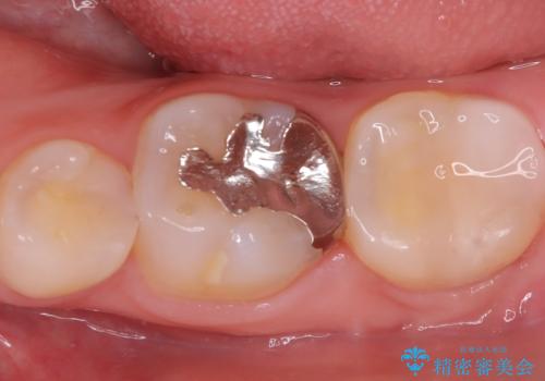 虫歯 〈セラミックインレー〉の治療後