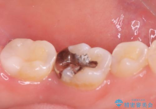 虫歯 〈セラミックインレー〉の治療後