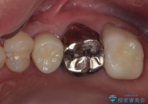 銀歯がとれたのでやり替えたい オールセラミッククラウンの症例 治療後