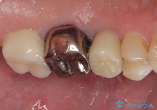 銀歯がとれたのでやり替えたい オールセラミッククラウンの治療後