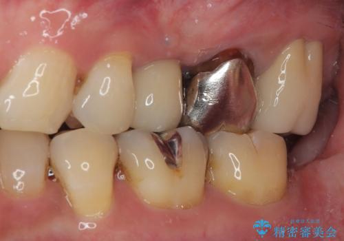 銀歯がとれたのでやり替えたい オールセラミッククラウンの治療後