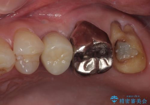 銀歯がとれたのでやり替えたい オールセラミッククラウンの治療中