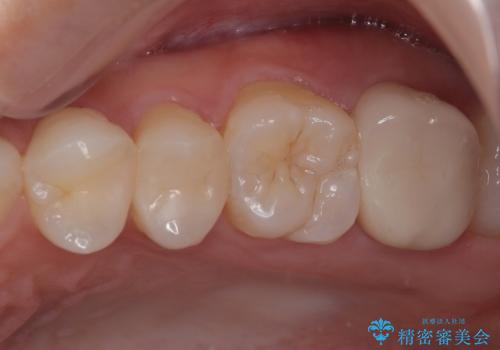 レジンが劣化してきた オールセラミッククラウンの症例 治療後