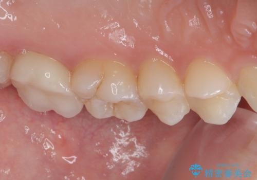 レジンが劣化してきた オールセラミッククラウンの治療後