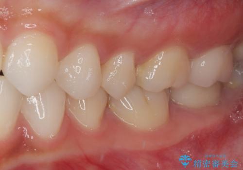 レジンが劣化してきた オールセラミッククラウンの治療後