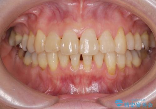 50代から始めるマウスピース矯正治療の症例 治療後