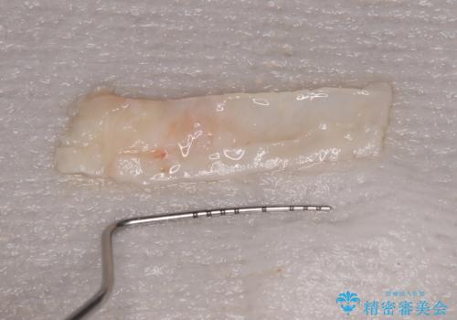 矯正治療で退縮した歯肉　歯肉移植術で露出した歯根を覆い隠すの治療後