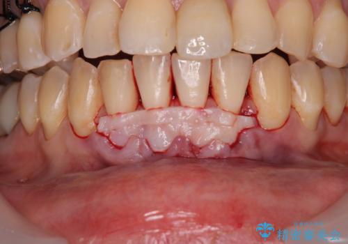 矯正治療で退縮した歯肉 歯肉移植術で露出した歯根を覆い隠すの治療前