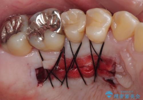 矯正治療で退縮した歯肉 歯肉移植術で露出した歯根を覆い隠すの治療中