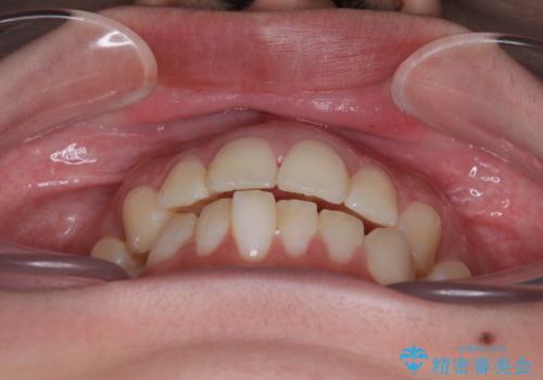 目立たないマウスピース矯正で下の前歯のデコボコをスッキリ解消!たった1年で整った歯並びにの治療前