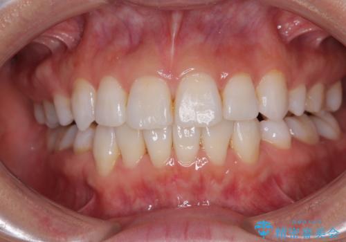 矯正治療の後戻り インビザラインで短期間矯正治療の治療中