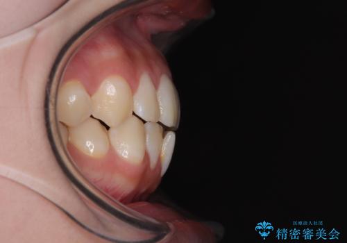 目立たないマウスピース矯正で下の前歯のデコボコをスッキリ解消!たった1年で整った歯並びにの治療前