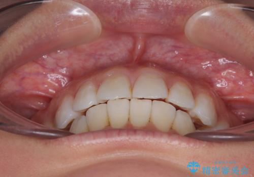 矯正治療の後戻り インビザラインで短期間矯正治療の治療中