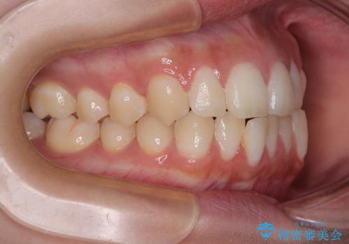 目立たないマウスピース矯正で下の前歯のデコボコをスッキリ解消!たった1年で整った歯並びにの治療前