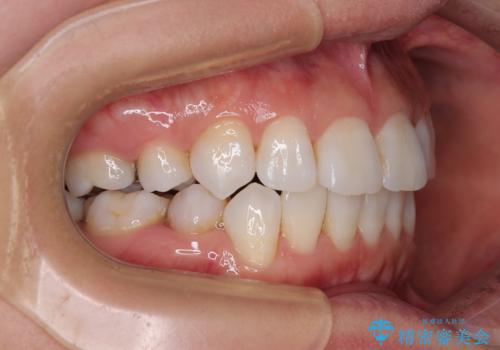 矯正治療の後戻り インビザラインで短期間矯正治療の治療中