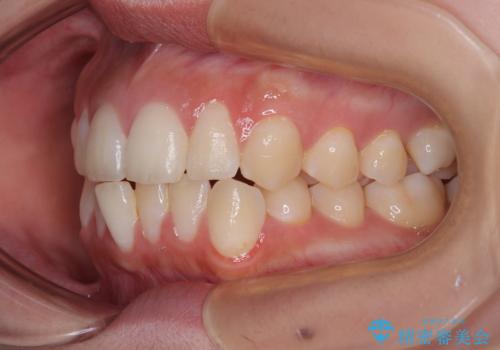 目立たないマウスピース矯正で下の前歯のデコボコをスッキリ解消!たった1年で整った歯並びにの治療前