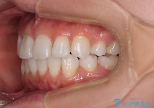 矯正治療の後戻り インビザラインで短期間矯正治療の治療中