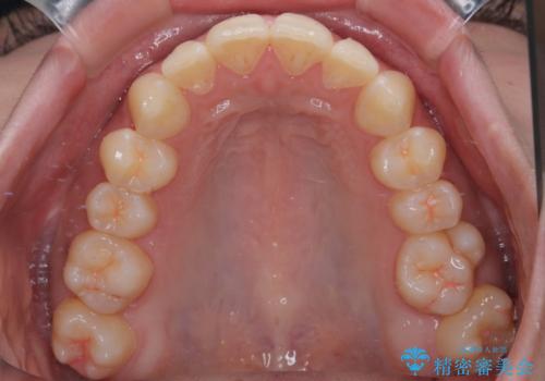 目立たないマウスピース矯正で下の前歯のデコボコをスッキリ解消!たった1年で整った歯並びにの治療前