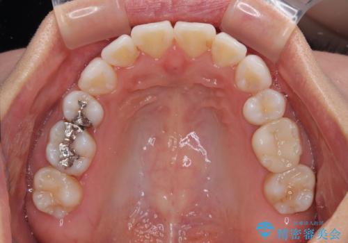 矯正治療の後戻り インビザラインで短期間矯正治療の治療中