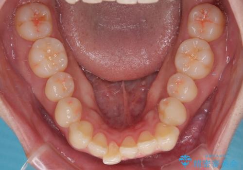 目立たないマウスピース矯正で下の前歯のデコボコをスッキリ解消!たった1年で整った歯並びにの治療前