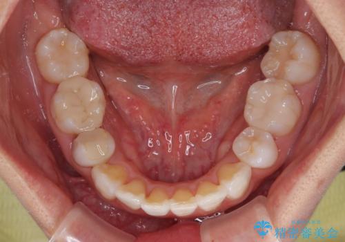 矯正治療の後戻り インビザラインで短期間矯正治療の治療中