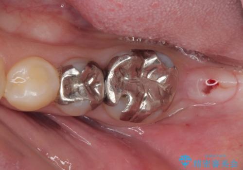 奥歯に歯を入れたい 即時荷重インプラントによる短期間インプラント治療の治療前