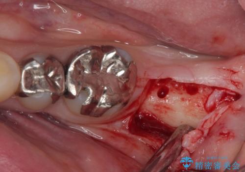 奥歯に歯を入れたい 即時荷重インプラントによる短期間インプラント治療の治療中