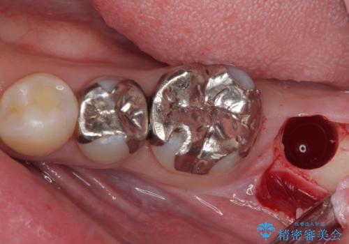 奥歯に歯を入れたい 即時荷重インプラントによる短期間インプラント治療の治療後