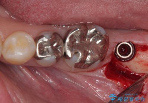 奥歯に歯を入れたい 即時荷重インプラントによる短期間インプラント治療の治療中