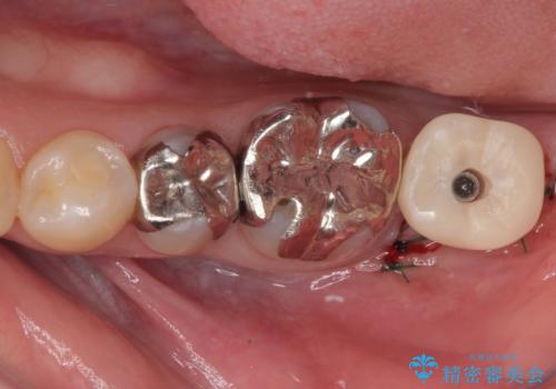奥歯に歯を入れたい 即時荷重インプラントによる短期間インプラント治療の治療中