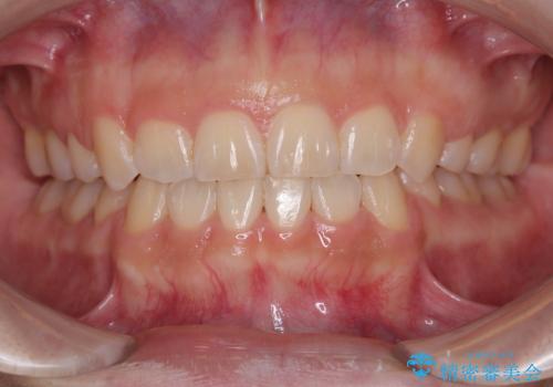 飛び出した前歯とデコボコ ワイヤー装置での抜歯矯正の症例 治療後
