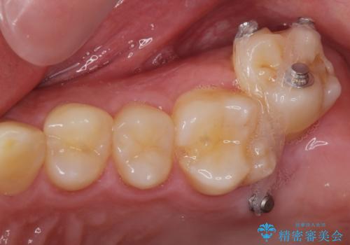 下の歯のがたつきが気になる。 インビザラン&ワイヤー部分矯正併用の治療中