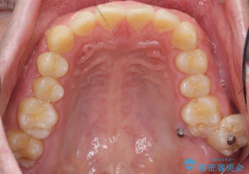 下の歯のがたつきが気になる。 インビザラン&ワイヤー部分矯正併用の治療中